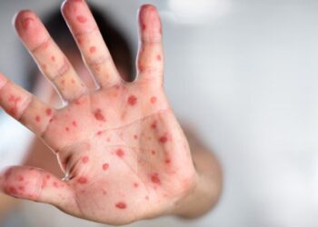 Қазақстанда ұл балалар қызылшамен жиірек ауырады