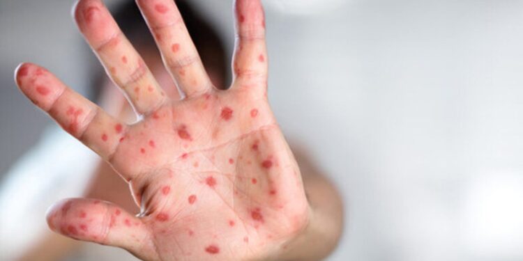 Қазақстанда ұл балалар қызылшамен жиірек ауырады