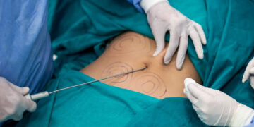 Артық салмағынан арыламын деп ажал құшты